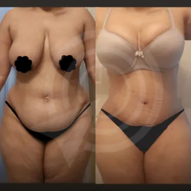 Tummy Tuck