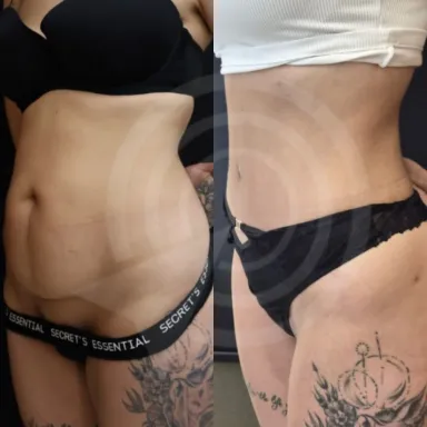 Tummy Tuck