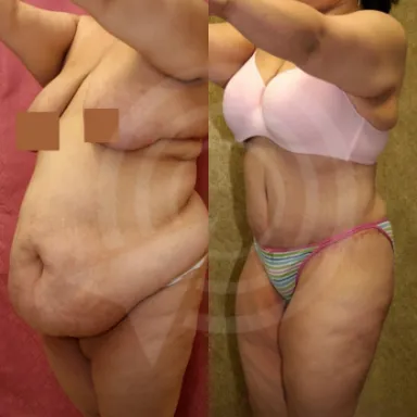 Tummy Tuck