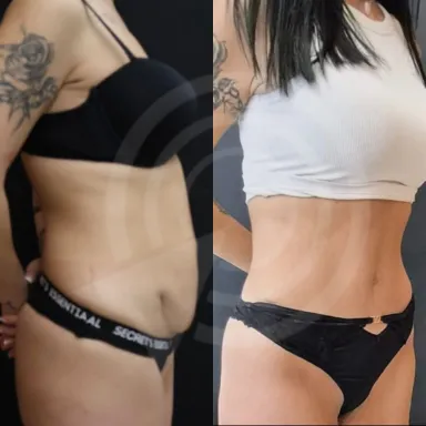 Tummy Tuck