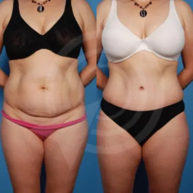 Tummy Tuck
