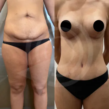 Tummy Tuck