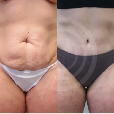 Tummy Tuck