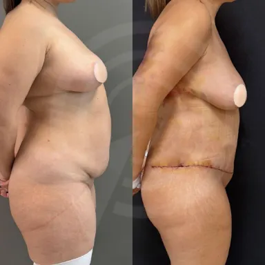 Tummy Tuck