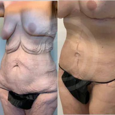 Tummy Tuck