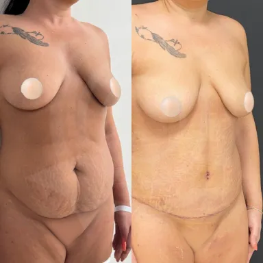 Tummy Tuck