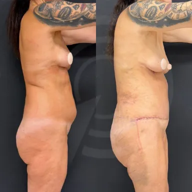Tummy Tuck