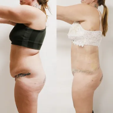 Tummy Tuck