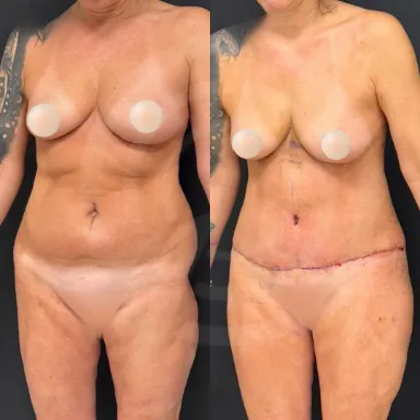 Tummy Tuck
