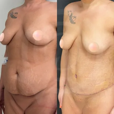 Tummy Tuck