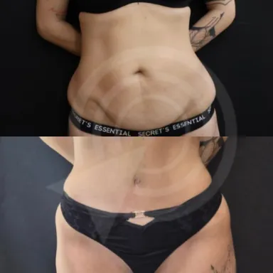 Tummy Tuck