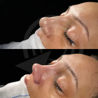 Rhinoplasty