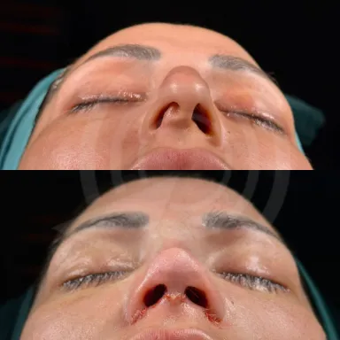Rhinoplasty