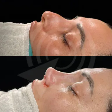 Rhinoplasty