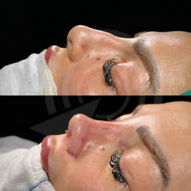 Rhinoplasty