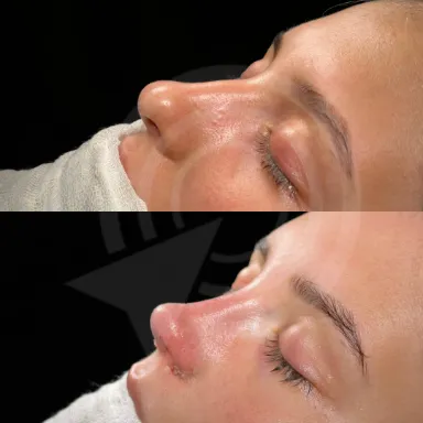 Rhinoplasty