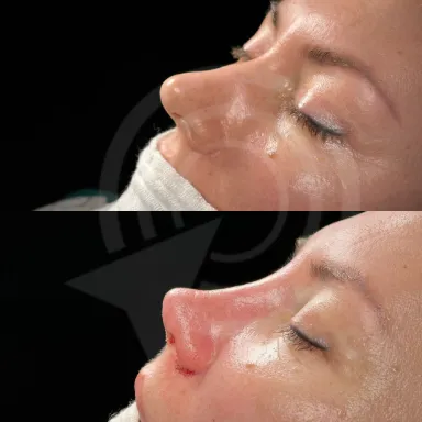 Rhinoplasty