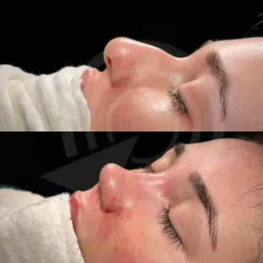 Rhinoplasty