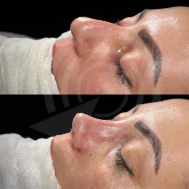 Rhinoplasty