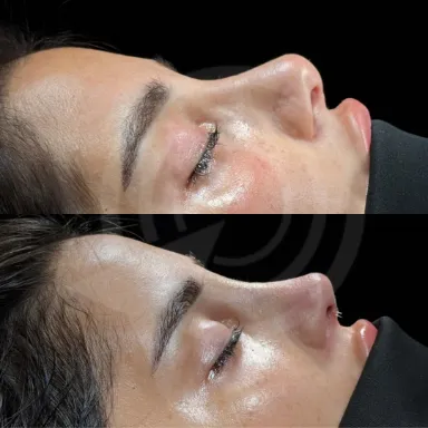 Rhinoplasty