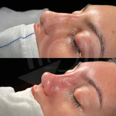 Rhinoplasty