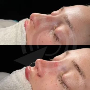 Rhinoplasty