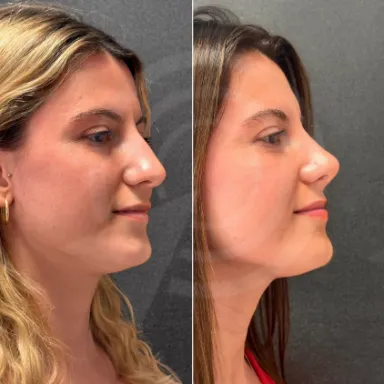 Rhinoplasty