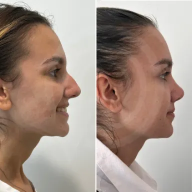 Rhinoplasty