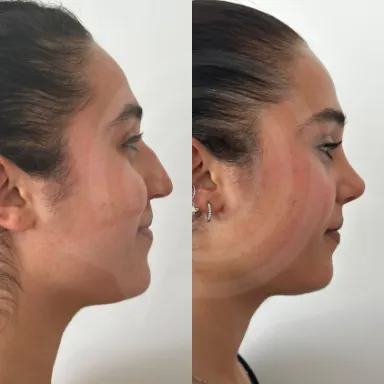 Rhinoplasty