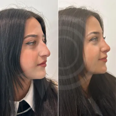 Rhinoplasty