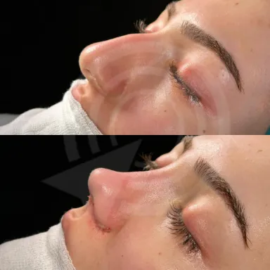 Rhinoplasty