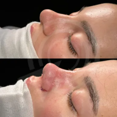 Rhinoplasty