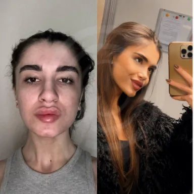 Rhinoplasty