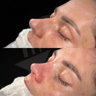 Rhinoplasty