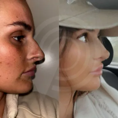 Rhinoplasty