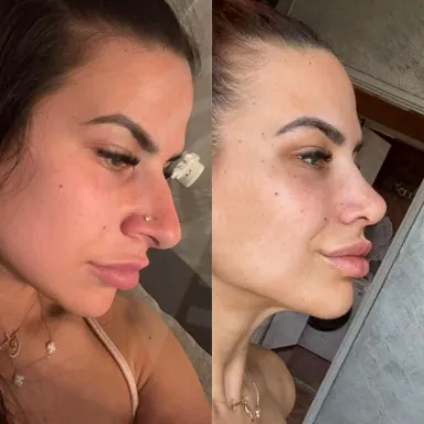 Rhinoplasty