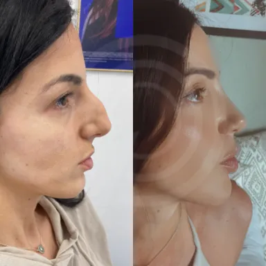 Rhinoplasty