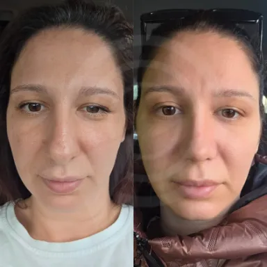 Rhinoplasty