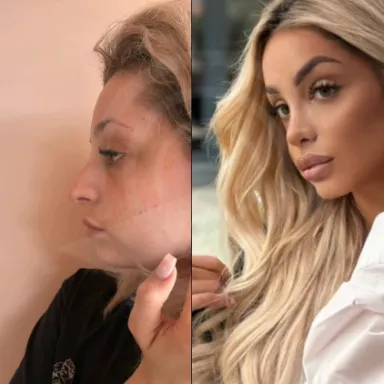 Rhinoplasty