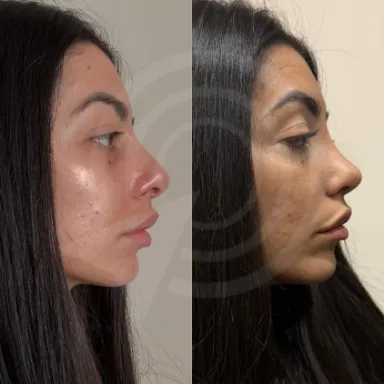 Rhinoplasty