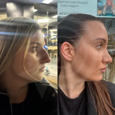 Rhinoplasty