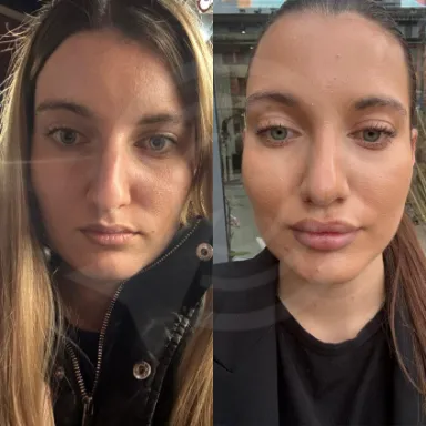 Rhinoplasty