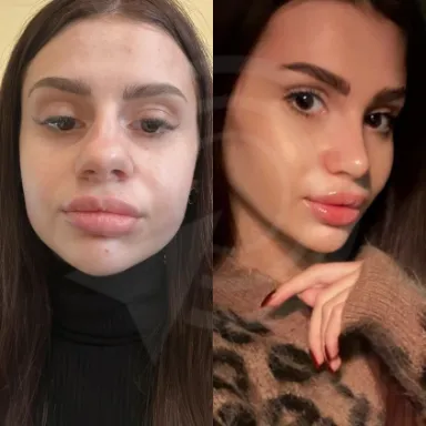 Rhinoplasty