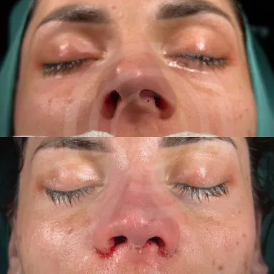 Rhinoplasty