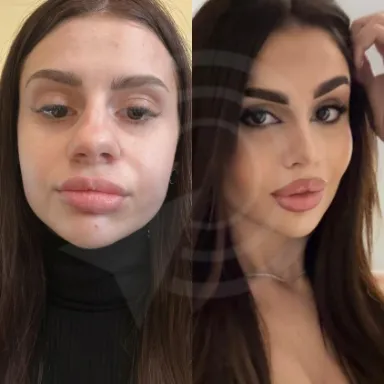 Rhinoplasty