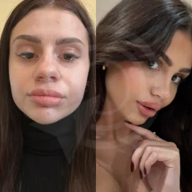 Rhinoplasty
