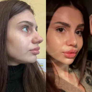 Rhinoplasty