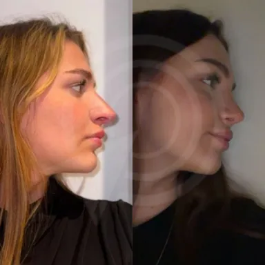 Rhinoplasty