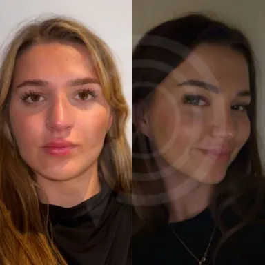 Rhinoplasty