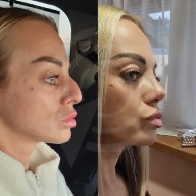 Rhinoplasty